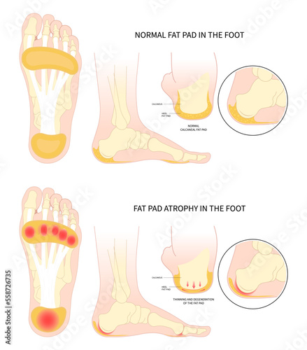 Painful heel bone spurs in Plantar fat pad atrophy tear high ankle shoes feet sport fascia arch of Lupus shots steroid for Achilles tendon photo