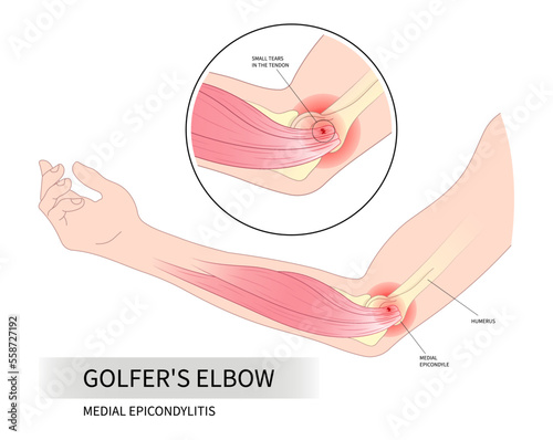 Print op canvas Golfer's elbow pain sport injury in pronation wrist common radial flexion rotato