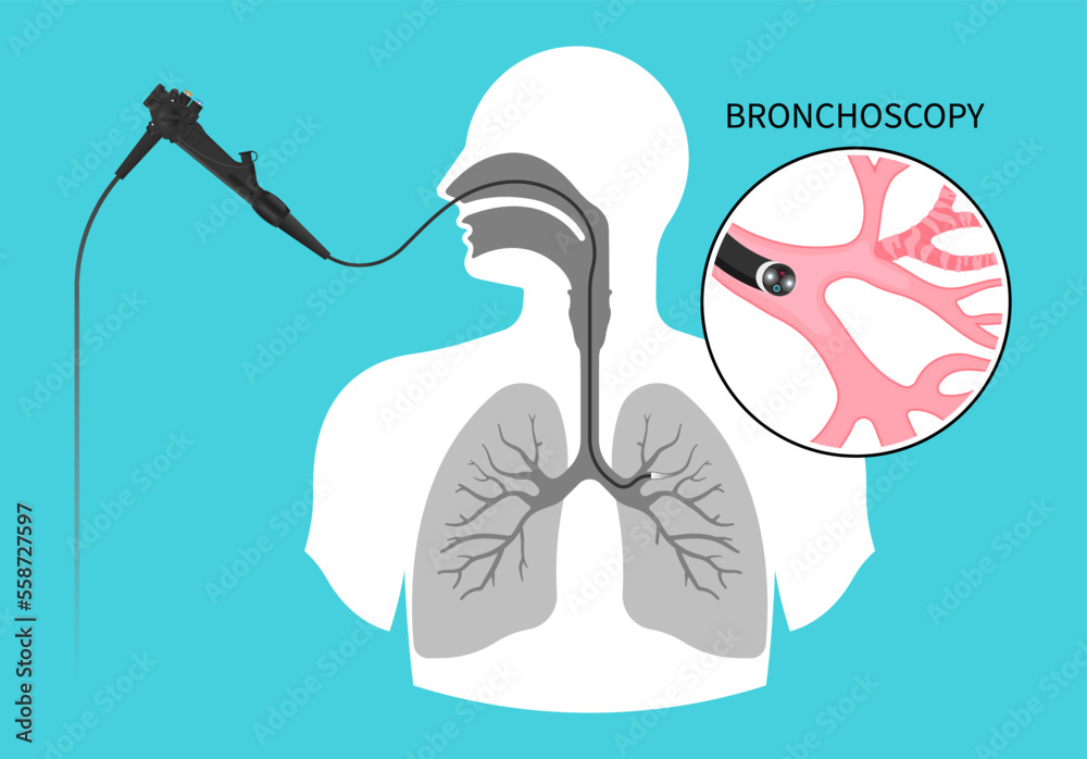 Chronic asthma test medical chest X RAY for Bronchioles tumor cancer malignant cell surgical