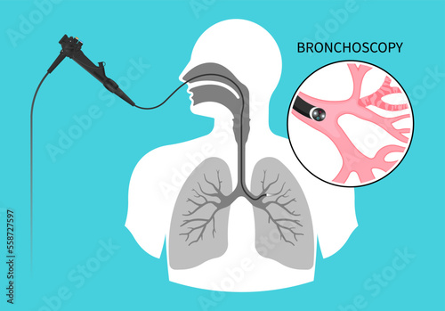 Chronic asthma test medical chest X RAY for Bronchioles tumor cancer malignant cell surgical with flexible fiber optic guided lymph node masses mucus plug bronchi washing
