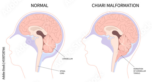 Anatomy of brain with Chiari malformation photo
