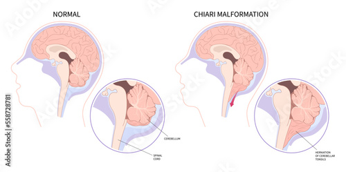 Anatomy of brain cancer tumor bleeding with Chiari malformation photo