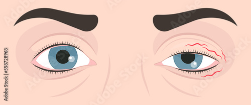 Droopy eye and anxiety fatigue stress lack of sleep twitch loss of myelin brainstem in Guillain Barré syndrome cancer tumor myasthenia gravis bell's palsy