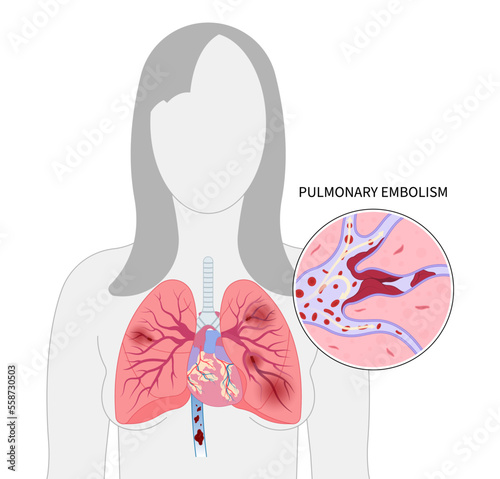 Swelling of lung blood vessel arteries clot chronic cough chest pain and leg thrombus air stroke edema spider vein high block acute limb ischemia knee ulcer foot calf post thrombotic