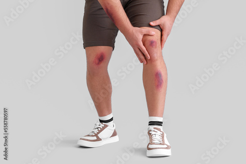 Man with bruises on legs against light background