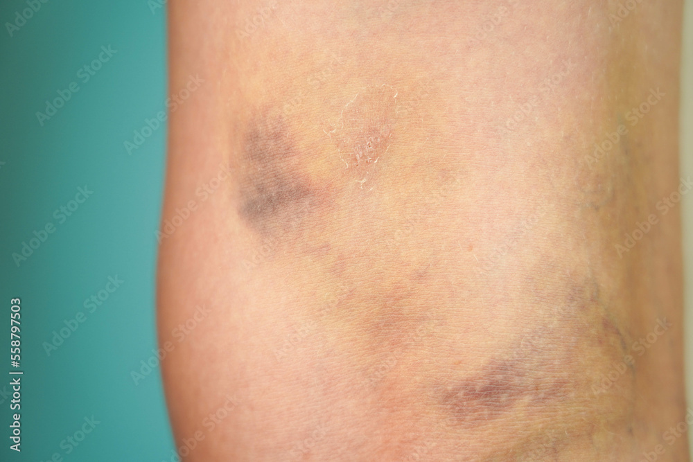 A large bruise on a woman's leg below the knee. Brown hematoma on the body A large bruise on a woman's leg below the knee. Brown hematoma on the body