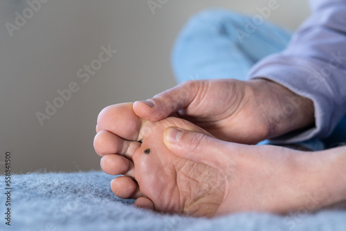 Man checks wart at home after cauterizing it with celandine on infected foot. Human papillomavirus or HPV. Verrucas papilloma callus virus. Viral skin infection concept. 