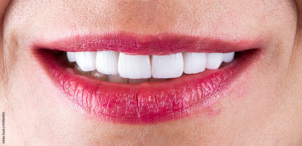 Fototapeta premium creating a new smile by ceramic crowns and veneers