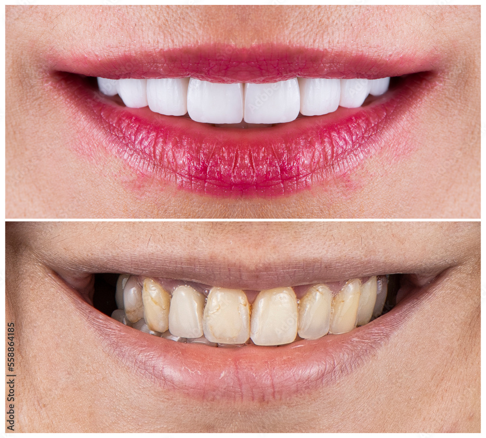 Obraz premium creating a new smile by ceramic crowns and veneers