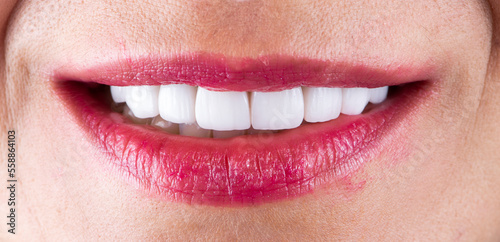 creating a new smile by ceramic crowns and veneers