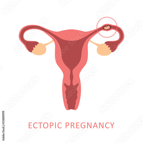 ectopic pregnancy female reproductive system women uterus photo
