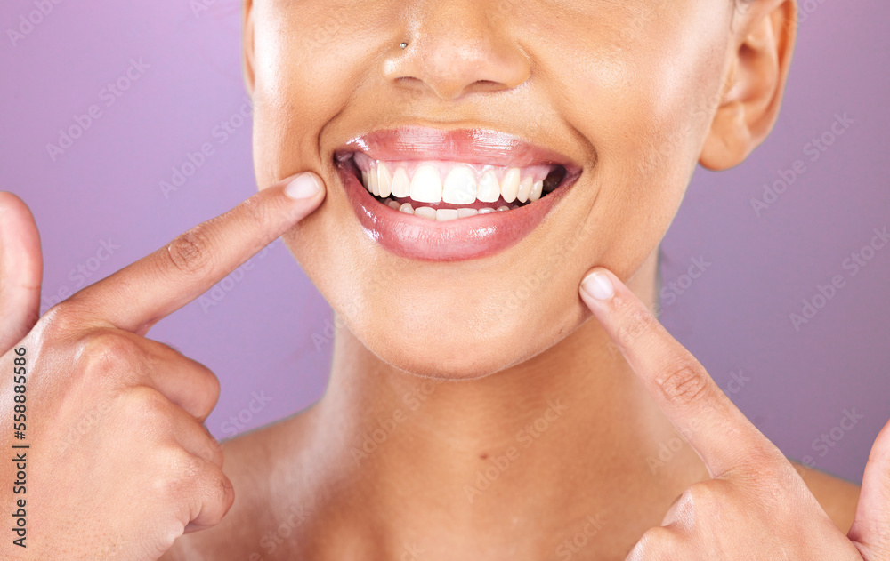 Naklejka premium Happy woman, face or dental care on purple studio background or teeth whitening, invisible braces treatment or grooming. Zoom on beauty model smile or cosmetic mouth hygiene and healthcare cleaning