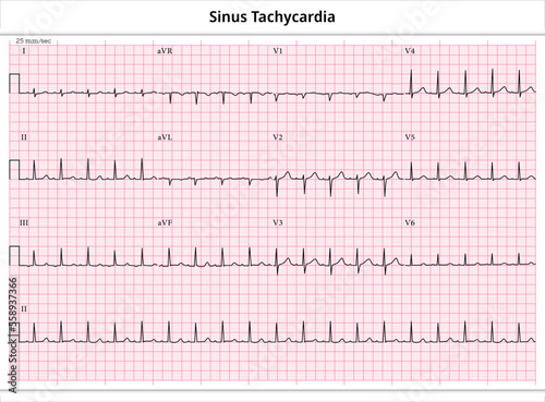 ECG Sinus Tachycardia - 12 Leads ECG Paper - Vector - Medical Illustration