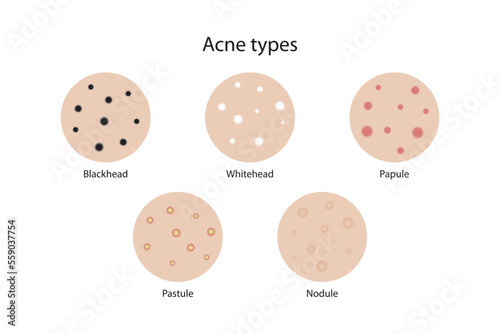Acne types