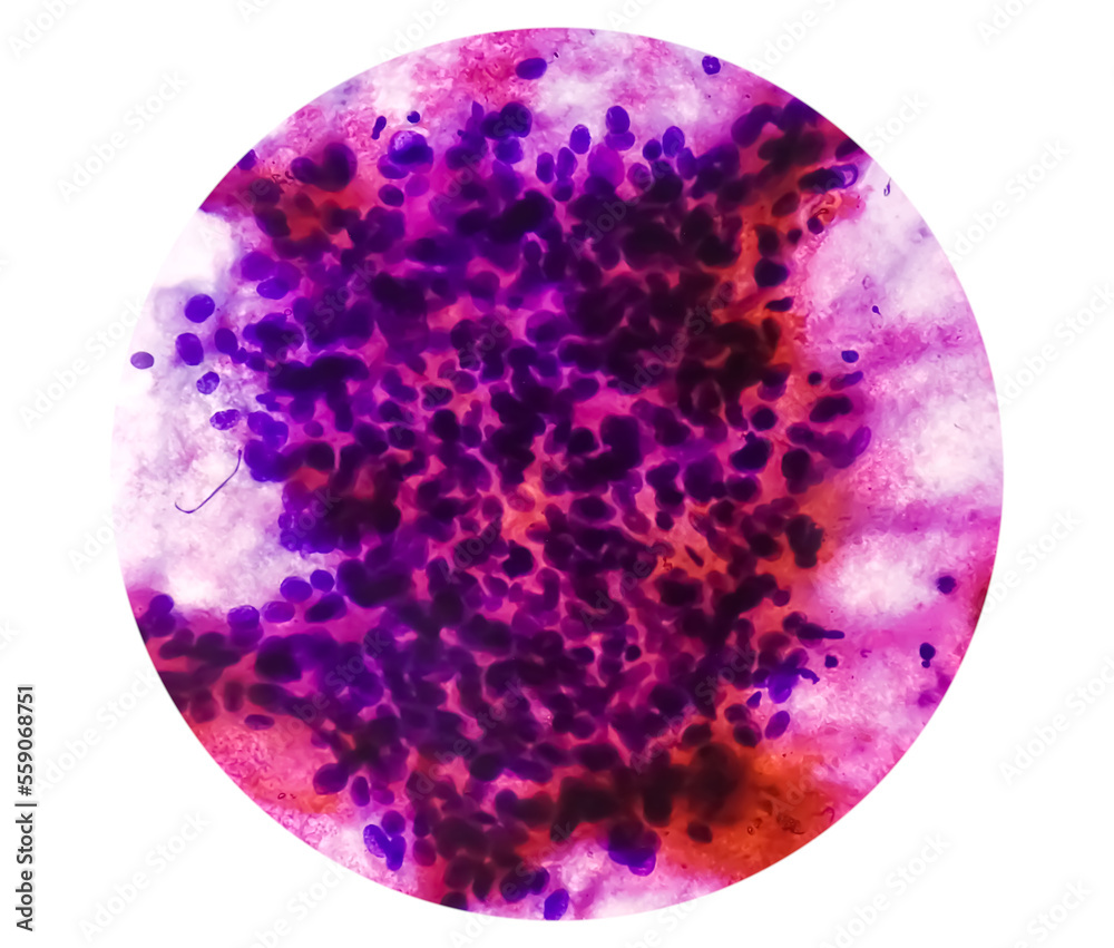 metastatic-adenocarcinoma-papillary-adenocarcinoma-a-type-of-non