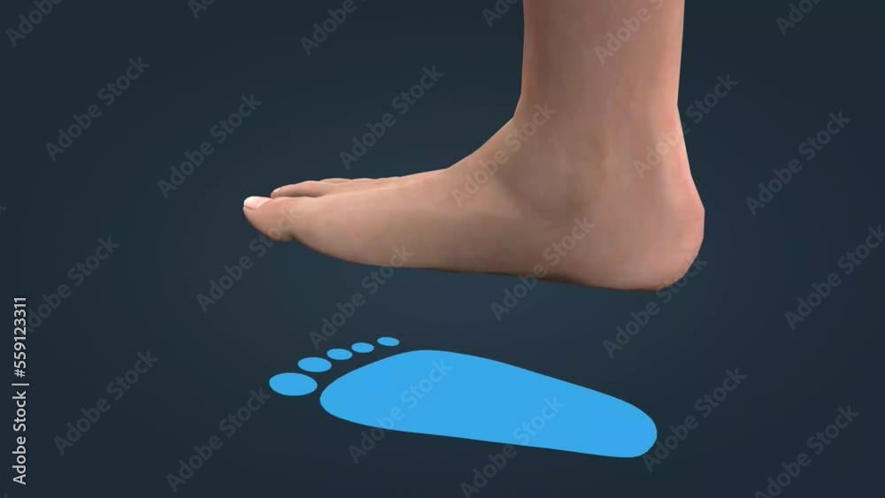 Flat feet is a common condition in which the arches on the inside of the feet flatten when