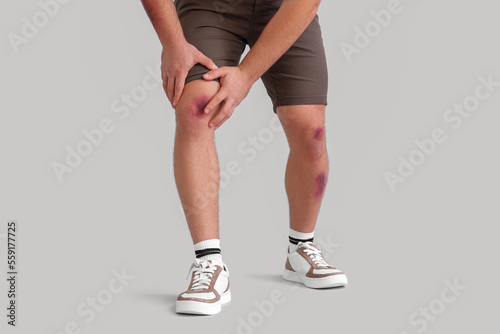 Man with bruises on legs against light background