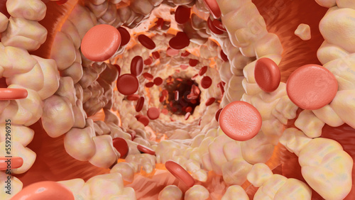 Hyperlipidemia concept. Fat deposits in blood vessels and red blood cell flow. Health care and medical. 3d render. photo