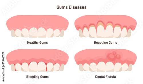 Human gum diseases set. Gums bleeding, receding and fistula.