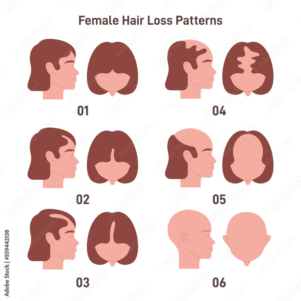 female-hair-loss-pattern-set-hair-loss-balding-process-female