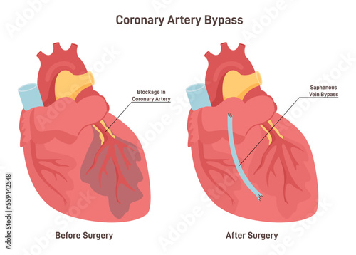 Coronary artery bypass. Damaged heart muscle, blockage of coronary artery.