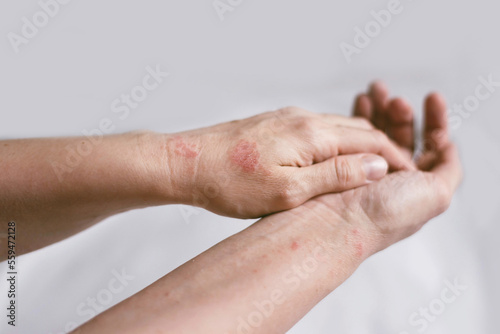 Itching on hands with redness rash. Cause of itchy skin include dermatitis  eczema   dry skin  burned  food drug allergies  insect bites. Health care concept.