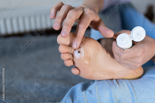 Man applies protective cream around wart plantar on his foot before cauterizing it with celandine extract. Alternative home treatment for warts. Verrucas papilloma callus virus or HPV. 