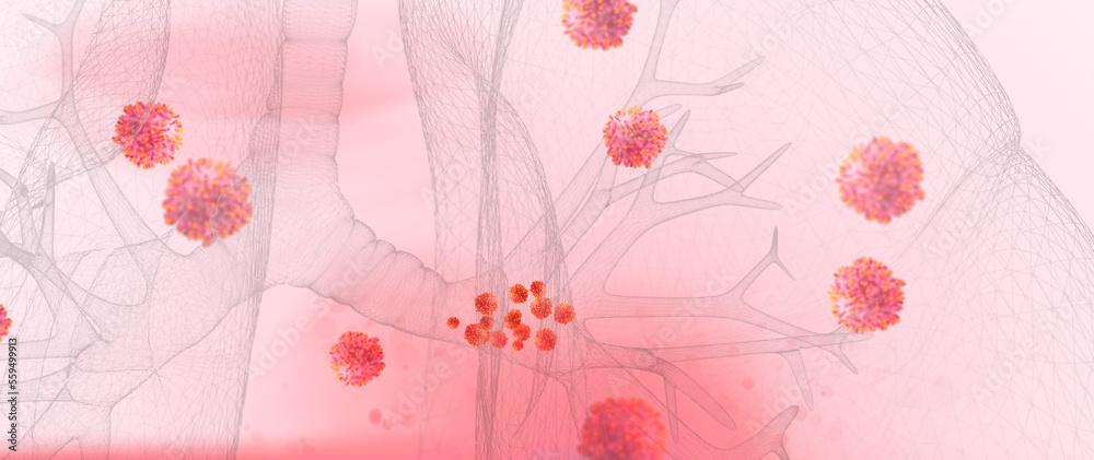 Respiratory Syncytial Virus Rsv In The Respiratory Tract The Rsv Virus Can Cause Respiratory