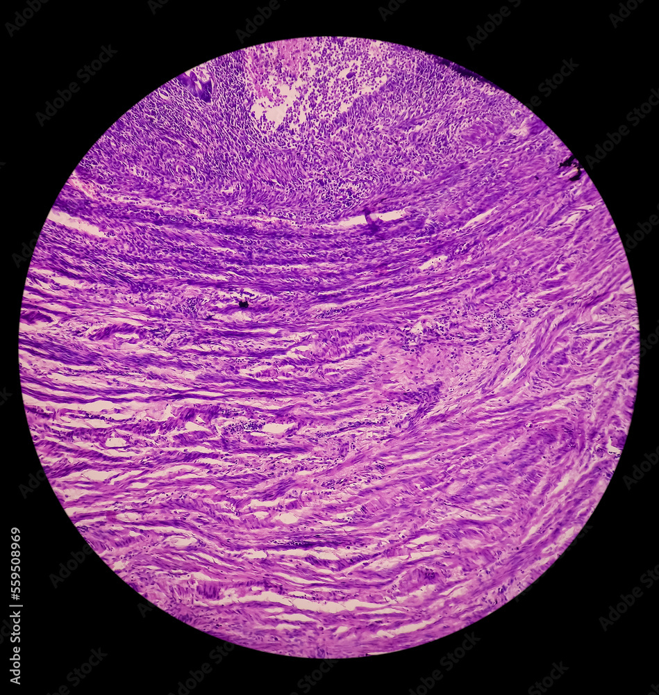 Uterus wall consist pyometra with cervicitis, photomicrograph show ...