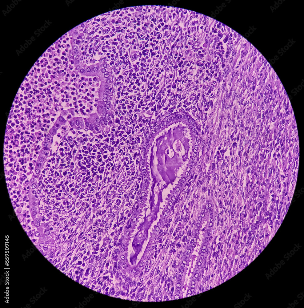 Uterus wall consist pyometra with cervicitis, photomicrograph show dense infiltration of polymorphs, lymphocytes, histiocytes and necrotic material. Uterus wall consist pyometra with cervicitis, photomicrograph show dense infiltration of polymorphs, lymphocytes, histiocytes and necrotic material.