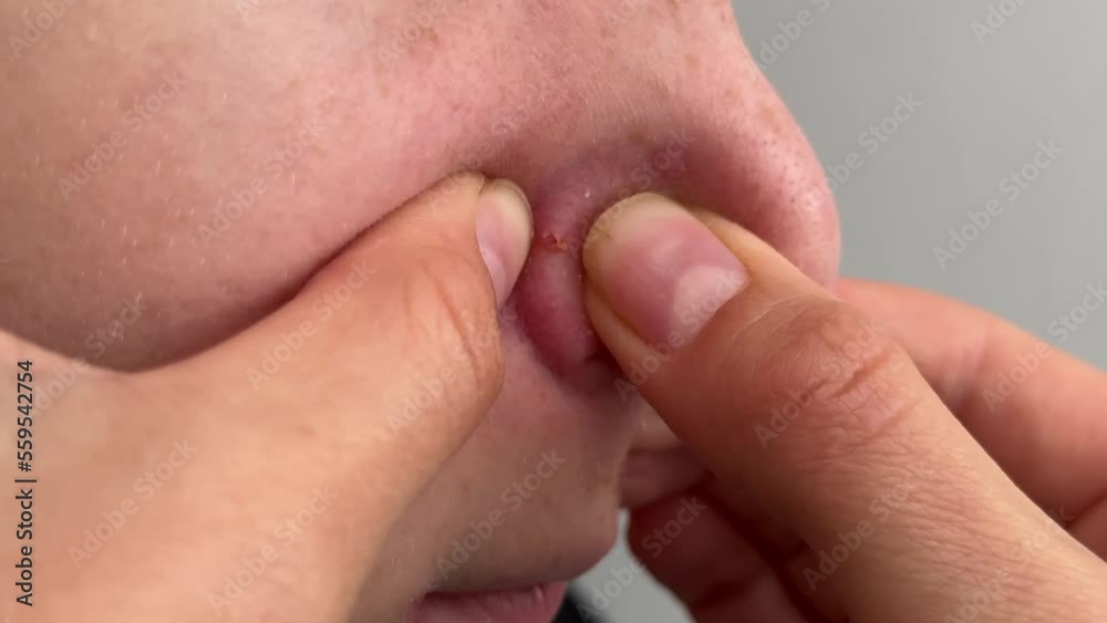 Cropped shot of teenager squeezing red inflamed pimple on nose, acne problems, comedones, concept of cosmetic dermatology and age related hormonal changes, pus and blood squeezed out of pimple. Cropped shot of teenager squeezing red inflamed pimple on nose, acne problems, comedones, concept of cosmetic dermatology and age related hormonal changes, pus and blood squeezed out of pimple.
