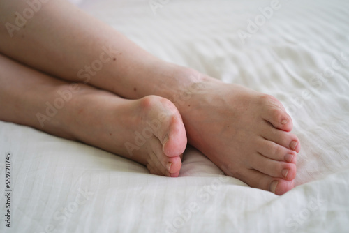 female legs on a white bed. The problem with women's feet. Hallus valgus © lesslemon