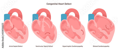 Congenital diseases of the heart set. Ventricular and atrial septal defect, photo
