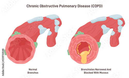 Chronic obstructive pulmonary disease. Chronic inflammatory lung disease