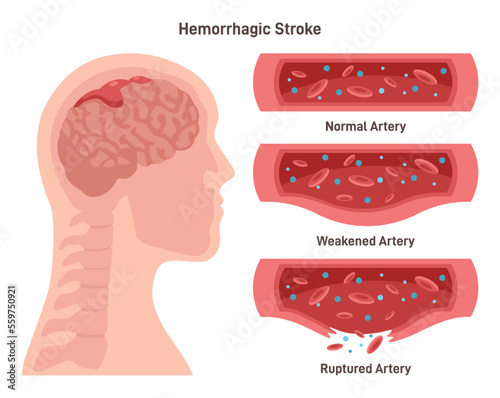 Hemorrhagic brain stroke. Damaged human brain,weakend and ruptured