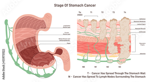 Stages of stomach cancer. Growth of pathological malignant cells