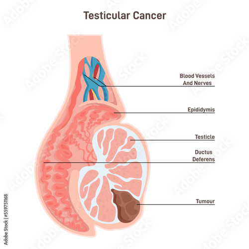 Testicular cancer. Pathological malignant tumor develops in the testicles. photo