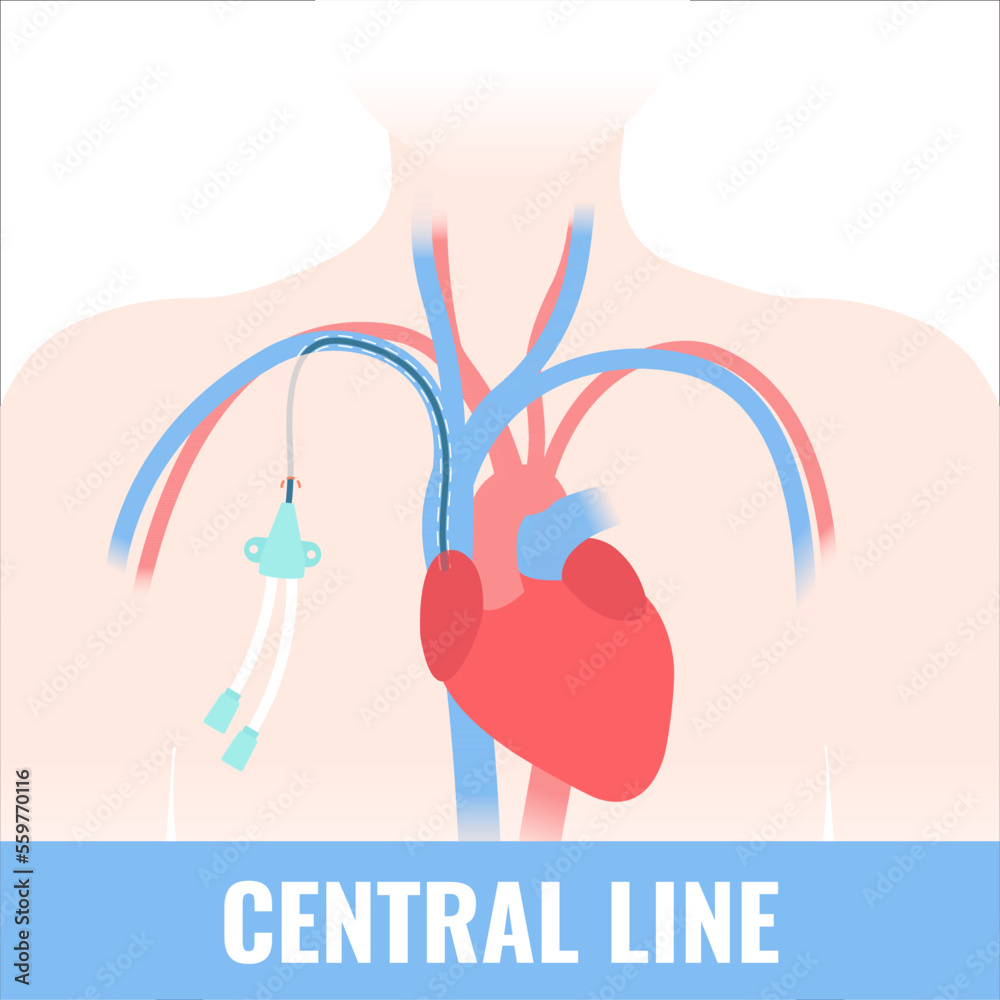 Tunneled central venous catheter placed in the subclavian vein. Patient with CVC long term
