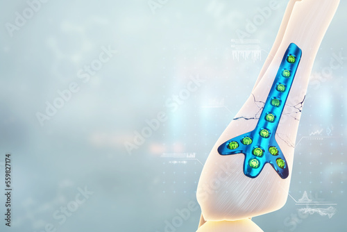 Medical procedure, osteosynthesis operation, surgical repositioning of leg bones. Fixation of a broken bone with a metal plate, technology, fixation of a fracture. 3D render, 3D illustration. photo