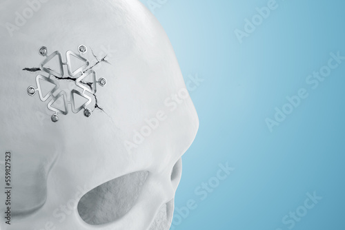 Medical procedure, osteosynthesis operation, surgical reposition of the skull. Fixation of a broken bone with a metal plate, technology, fixation of a fracture. 3D render, 3D illustration. photo