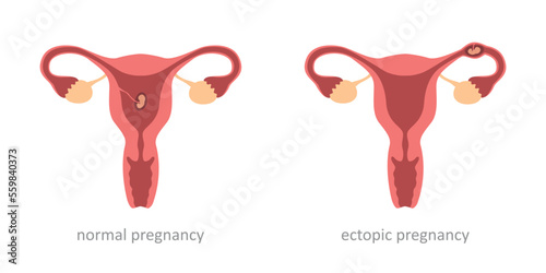 womens health normal and ectopic pregnancy embryo