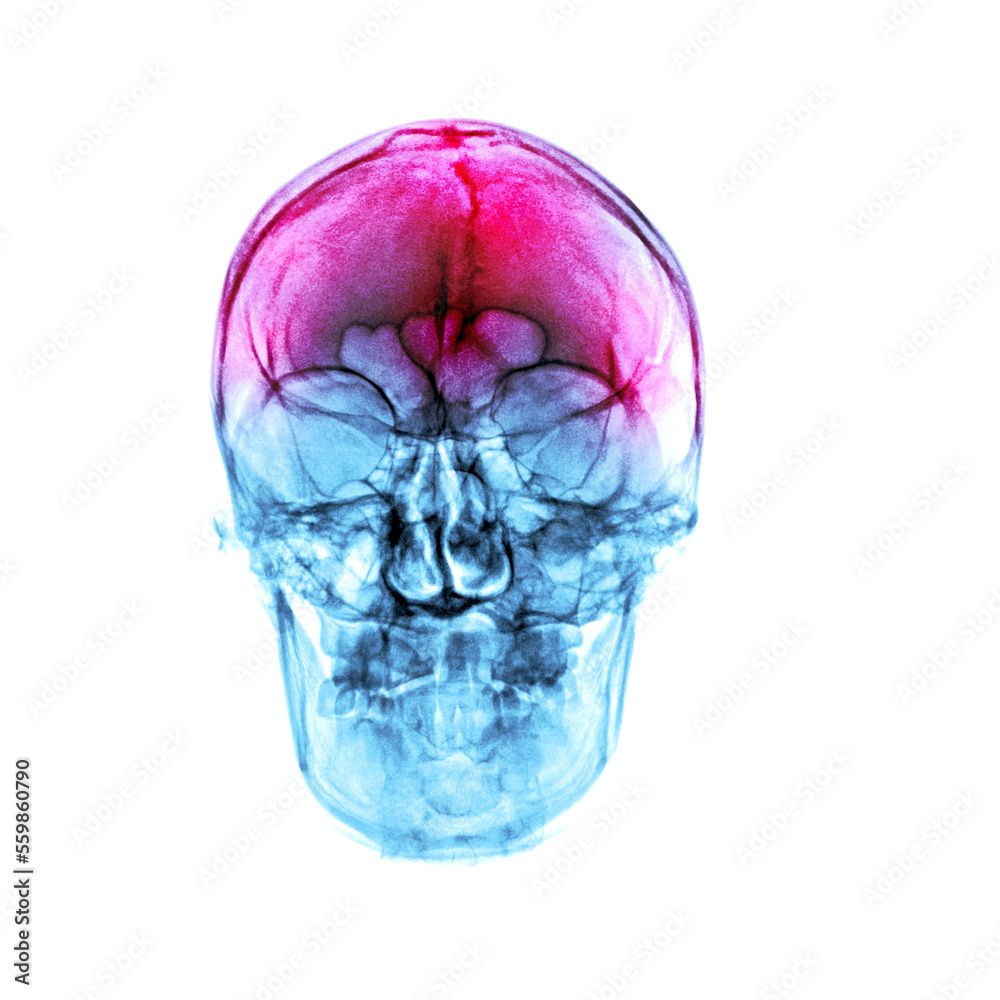 Headache . Film x-ray human skull . front view . Headache . Film x-ray human skull . front view .