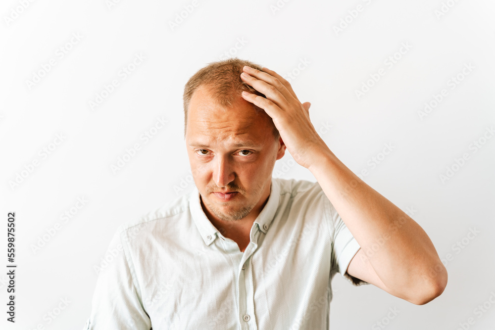 Before hair transplantation. Young sad bald man with depression at hair loss problems looking angry and frustrated and holding his head. Before hair transplantation. Young sad bald man with depression at hair loss problems looking angry and frustrated and holding his head.