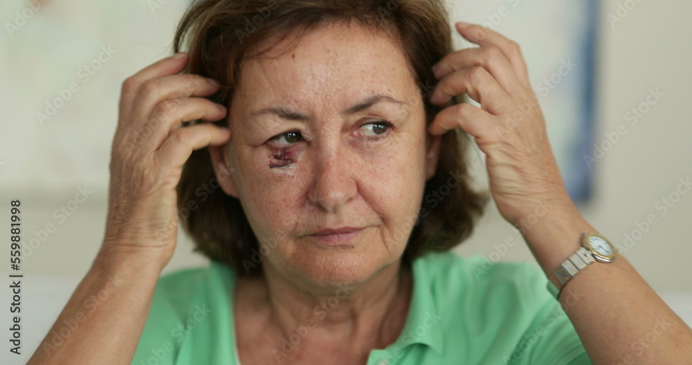 Older woman with bruised face adjusting hair Older woman with bruised face adjusting hair