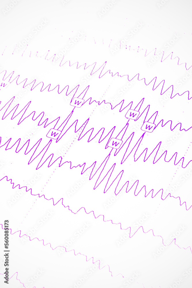 Results of electroencephalogram on paper, diagnostics of epilepsy