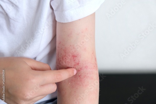 The child scratches atopic skin. Dermatitis, diathesis, allergy on the child's body.	 photo
