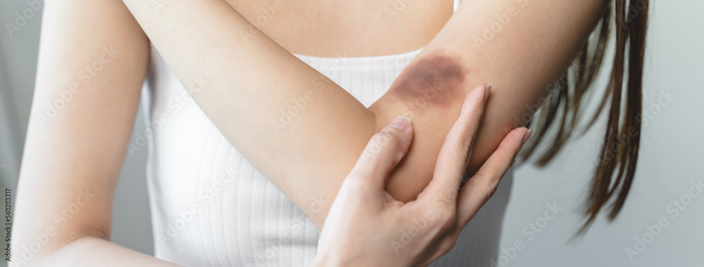 woman get injured and have bruised on her arm.