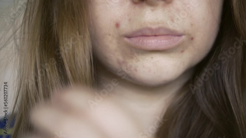 Close up of skin problems, unhealthy skin with acne and pimples. Porous, demodex and rosacea, red rashes. The concept of care for problem skin. Allergic and redness. photo