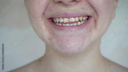 A young girl smiles and shows crooked teeth. The concept of dental problems.