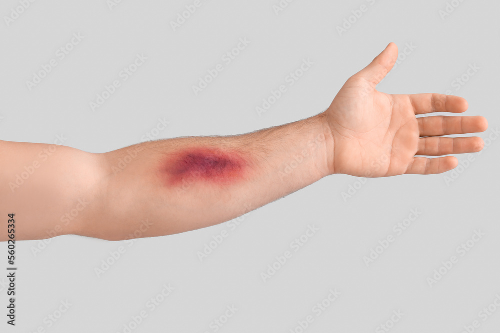 Male arm with bruise on light background